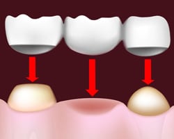 Dental Bridge Dental Bridge