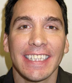 crowding-with-overbite