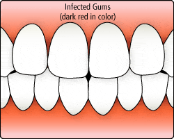 gingivitis gingivitis