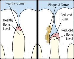 periodontitis periodontitis