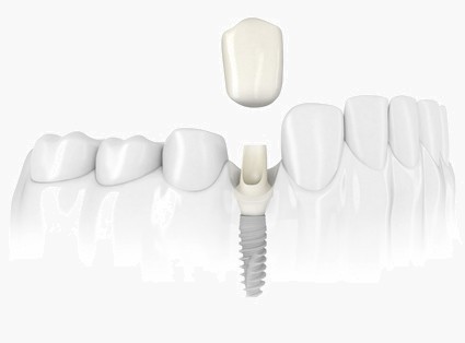 single-implants single-implants