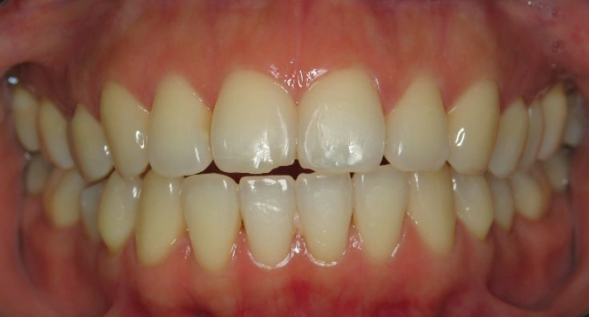 invisalign 1 after
