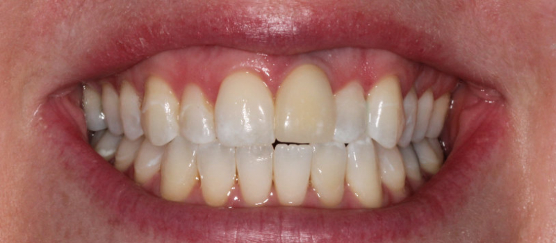 single implant crown and single porcelain veneer before